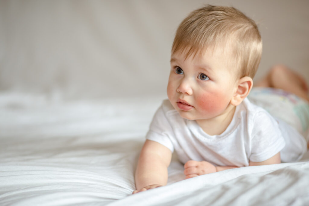 Baby liegt auf dem Bauch und hat Neurodermitis auf den Wangen