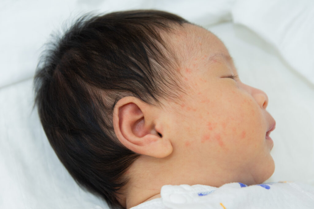 Neurodermitis Baby Symptome sind typisch am Kopf