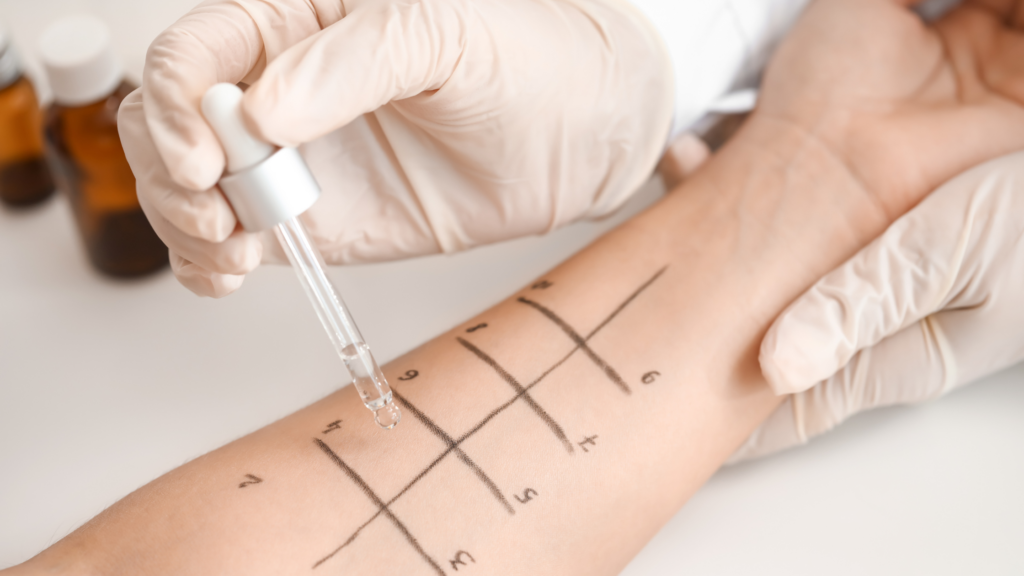 Allergietest auf dem Unterarm wird durchgeführt